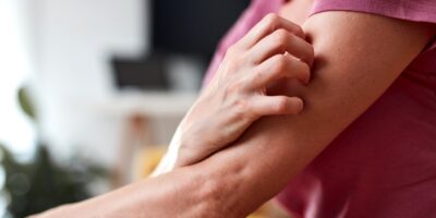 Rashes and Hives: Causes, Symptoms, and Treatment